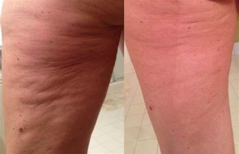 red-light-therapy-cellulite-reduction
