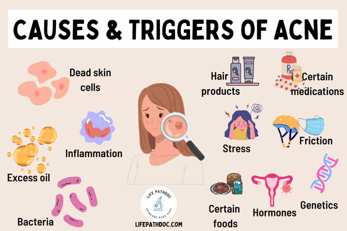 causes of acne