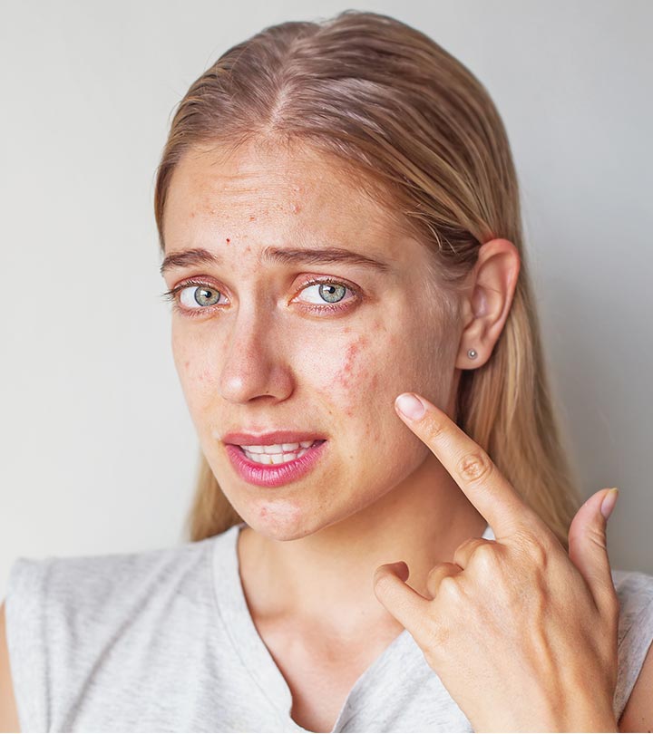 Acne Breakouts and Scarring: Tips for Oily Skin Care