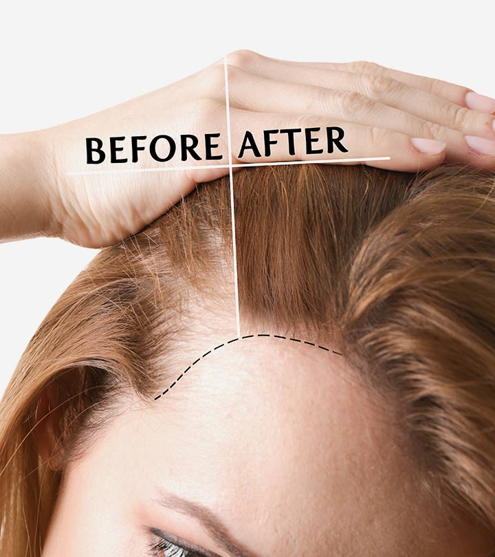 Steps Before Your Irvine Hair Transplant Procedure